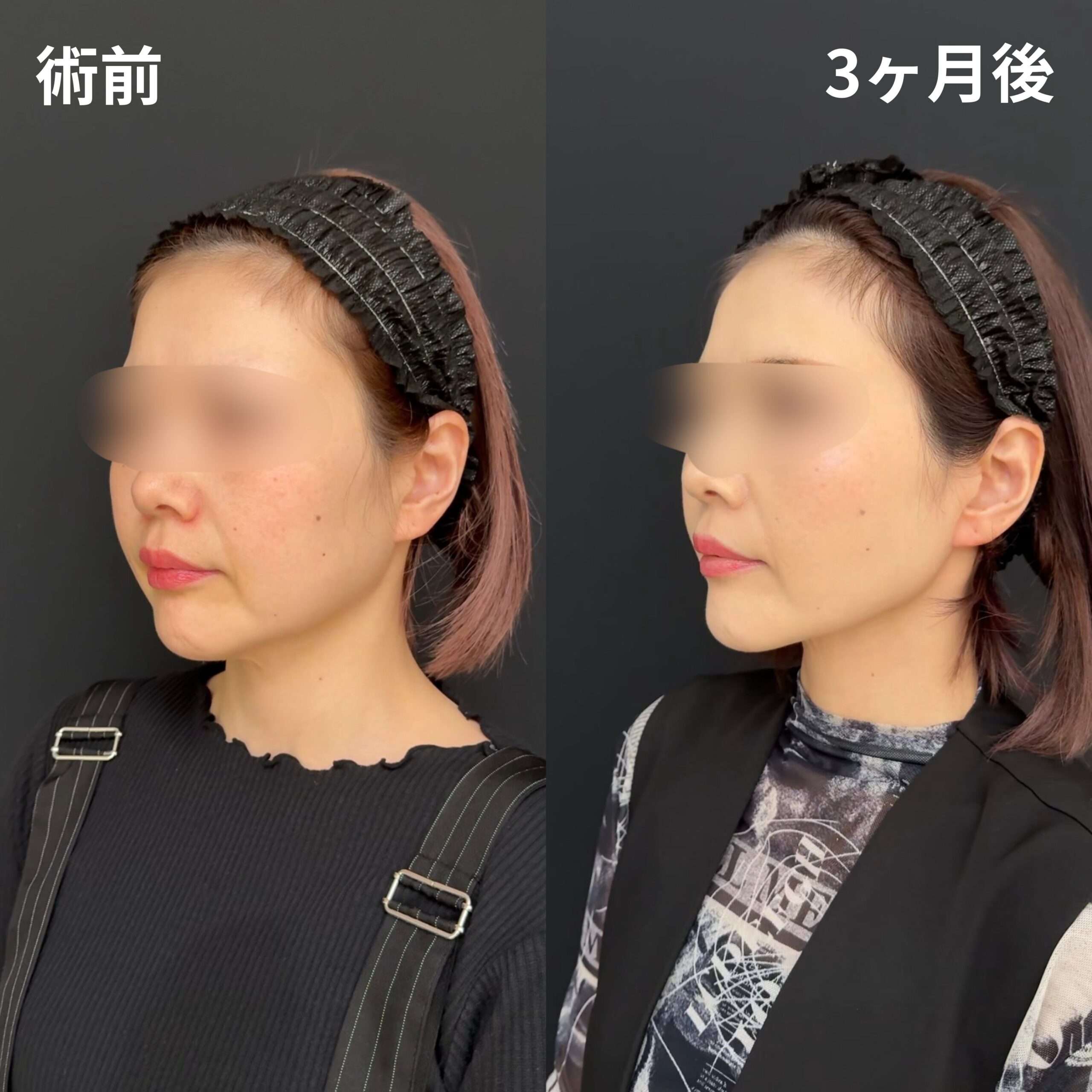 <br />
<b>Warning</b>:  Undefined variable $image_alt in <b>/home/r9092703/public_html/4dclinic.jp/wp/wp-content/themes/4d-clinic/single-case.php</b> on line <b>109</b><br />
