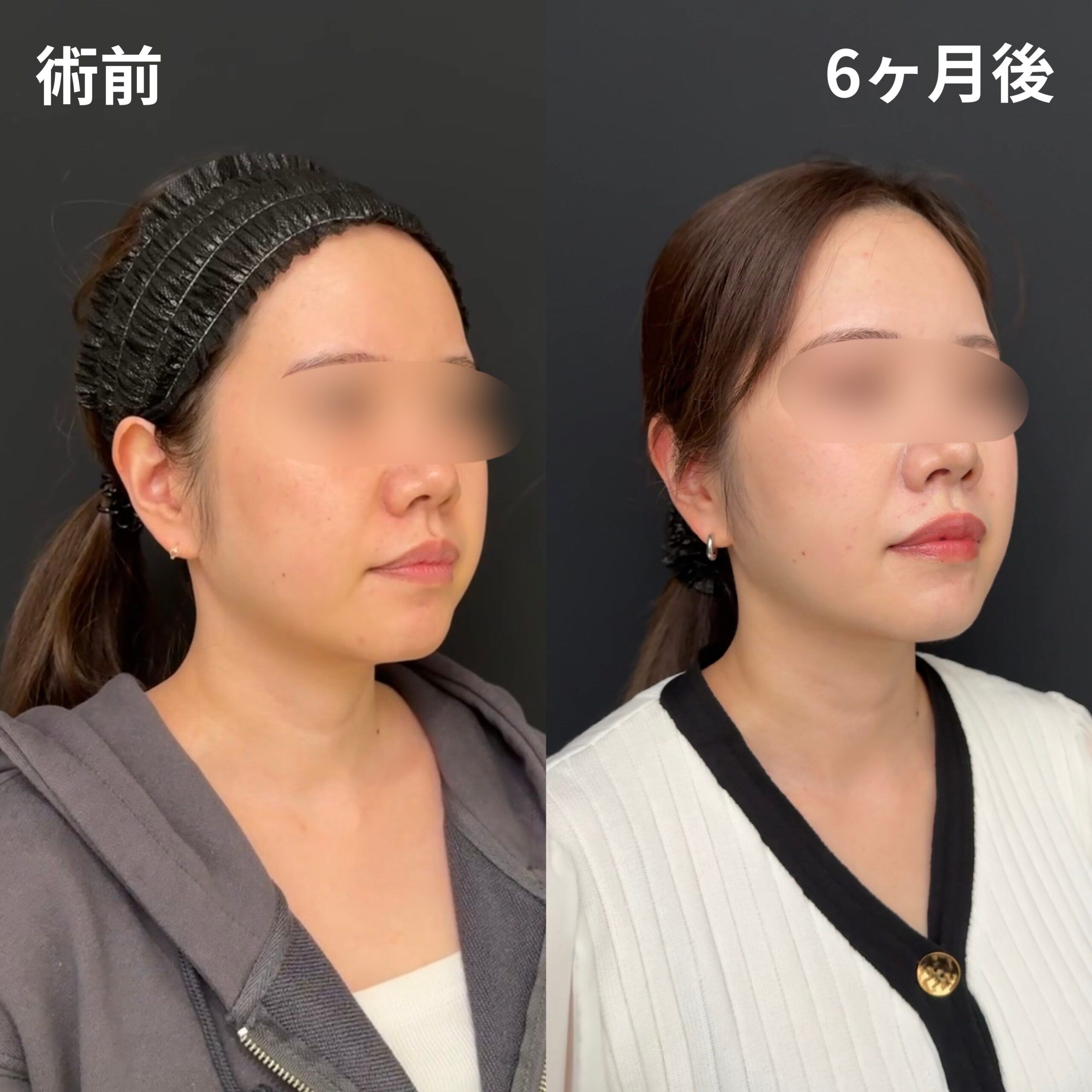 ほほ・あご下・糸リフト