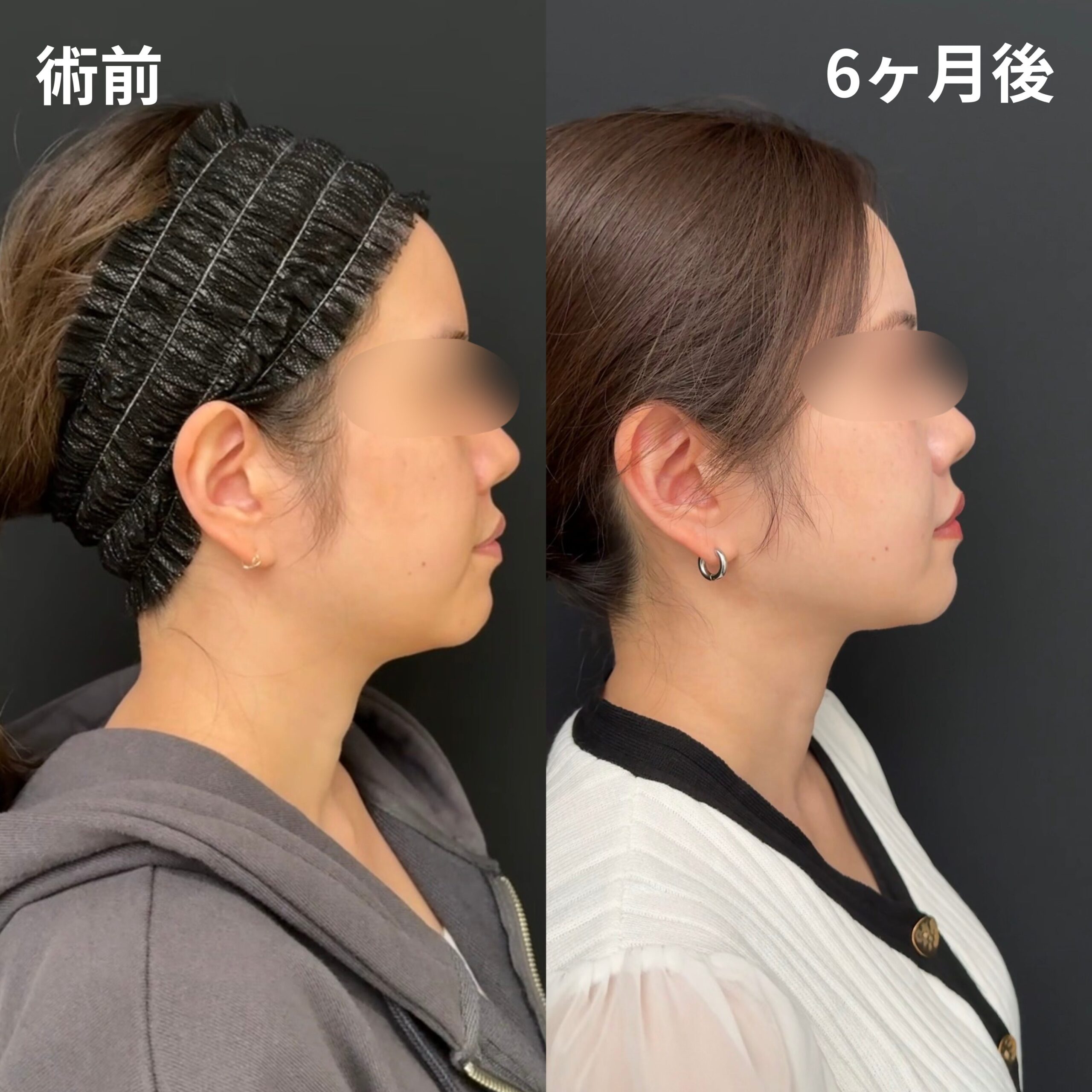 <br />
<b>Warning</b>:  Undefined variable $image_alt in <b>/home/r9092703/public_html/4dclinic.jp/wp/wp-content/themes/4d-clinic/single-case.php</b> on line <b>109</b><br />
