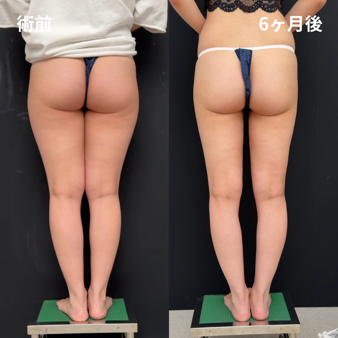 大腿全周・臀部・膝・エンブレイスRF（大腿全周）