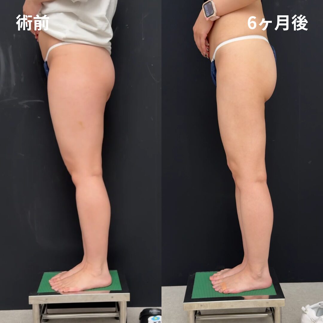 <br />
<b>Warning</b>:  Undefined variable $image_alt in <b>/home/r9092703/public_html/4dclinic.jp/wp/wp-content/themes/4d-clinic/single-case.php</b> on line <b>109</b><br />
