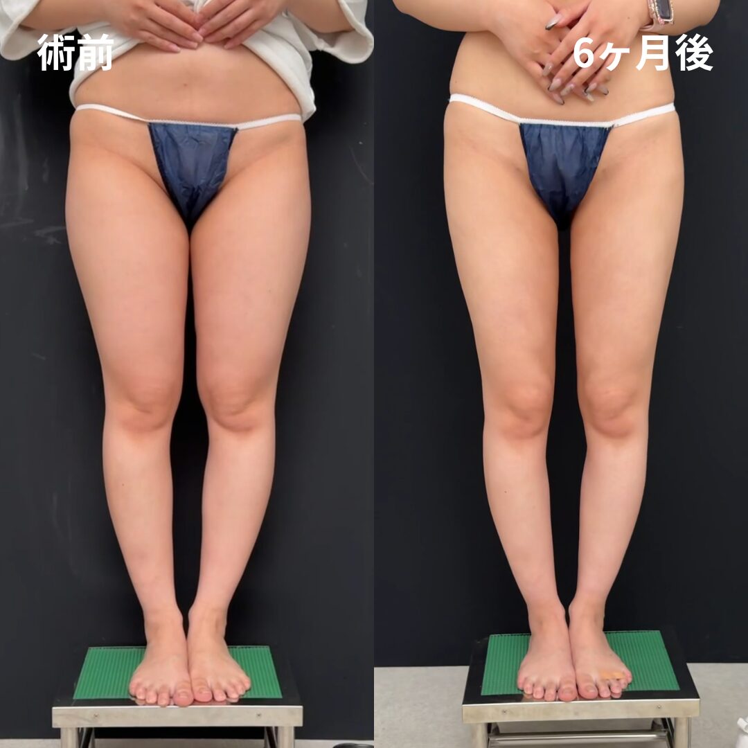 <br />
<b>Warning</b>:  Undefined variable $image_alt in <b>/home/r9092703/public_html/4dclinic.jp/wp/wp-content/themes/4d-clinic/single-case.php</b> on line <b>109</b><br />
