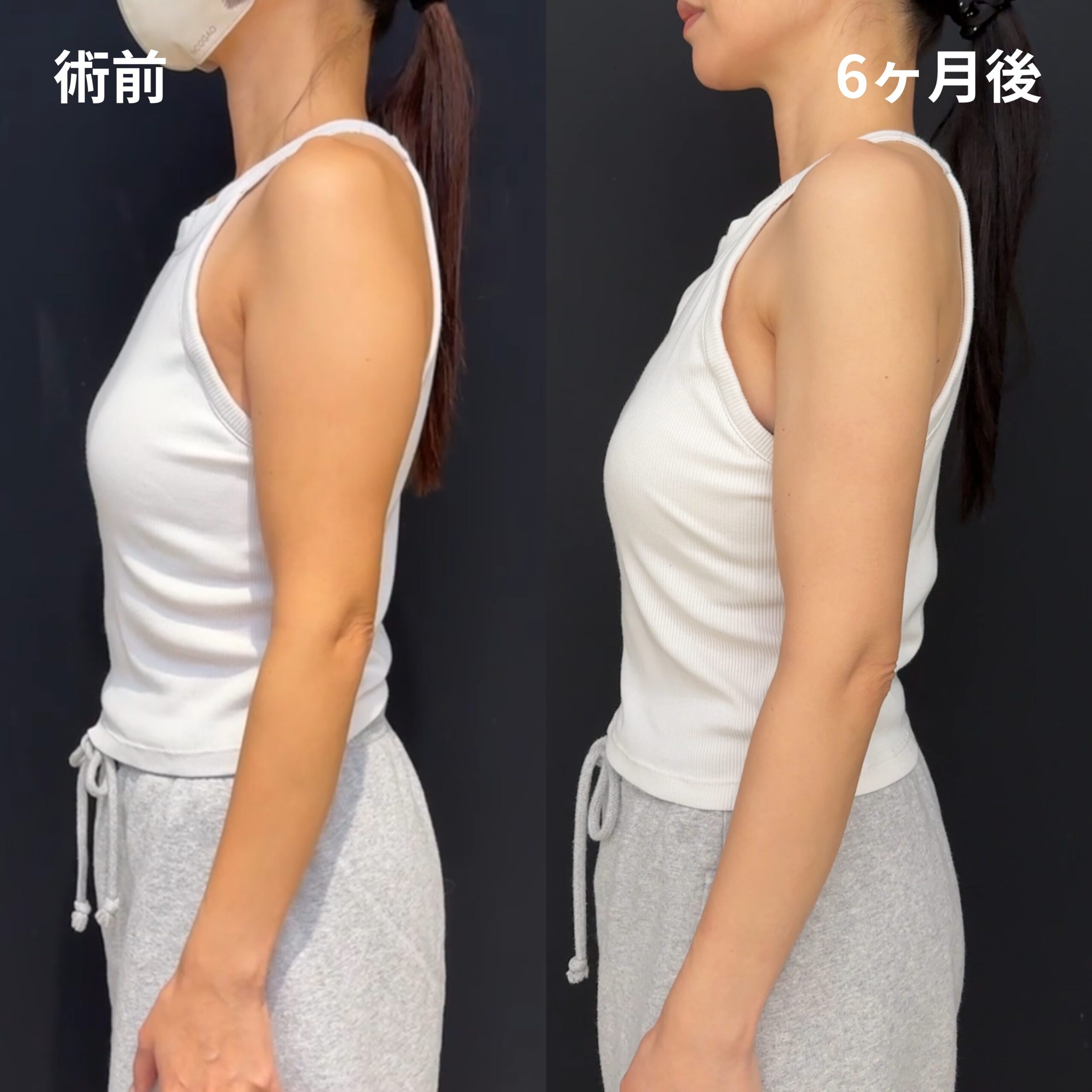 <br />
<b>Warning</b>:  Undefined variable $image_alt in <b>/home/r9092703/public_html/4dclinic.jp/wp/wp-content/themes/4d-clinic/single-case.php</b> on line <b>109</b><br />
