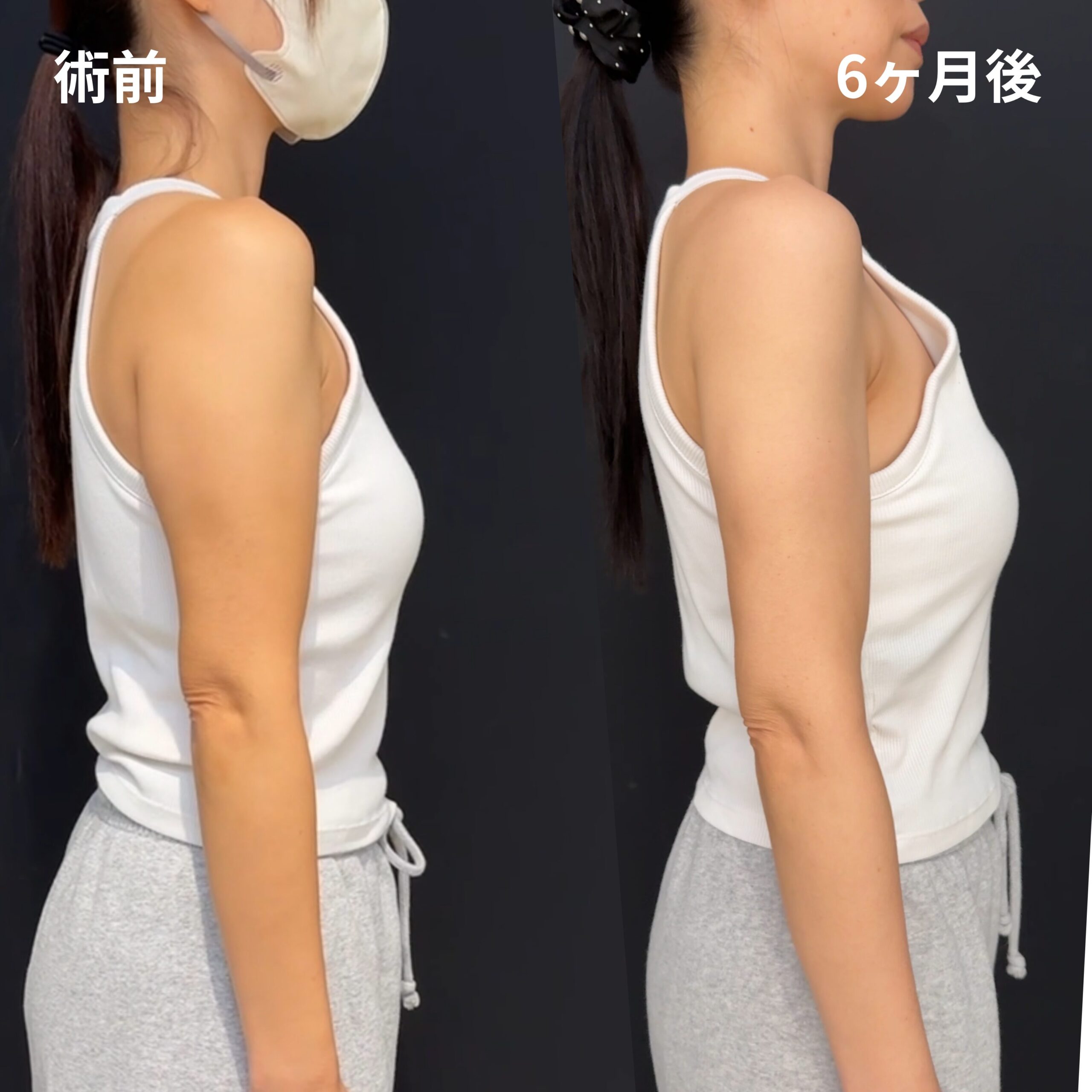 二の腕全周・肩・肩甲骨横・脇肉副乳・ブラ上下・他院修正・エンブレイスRF（二の腕全周）