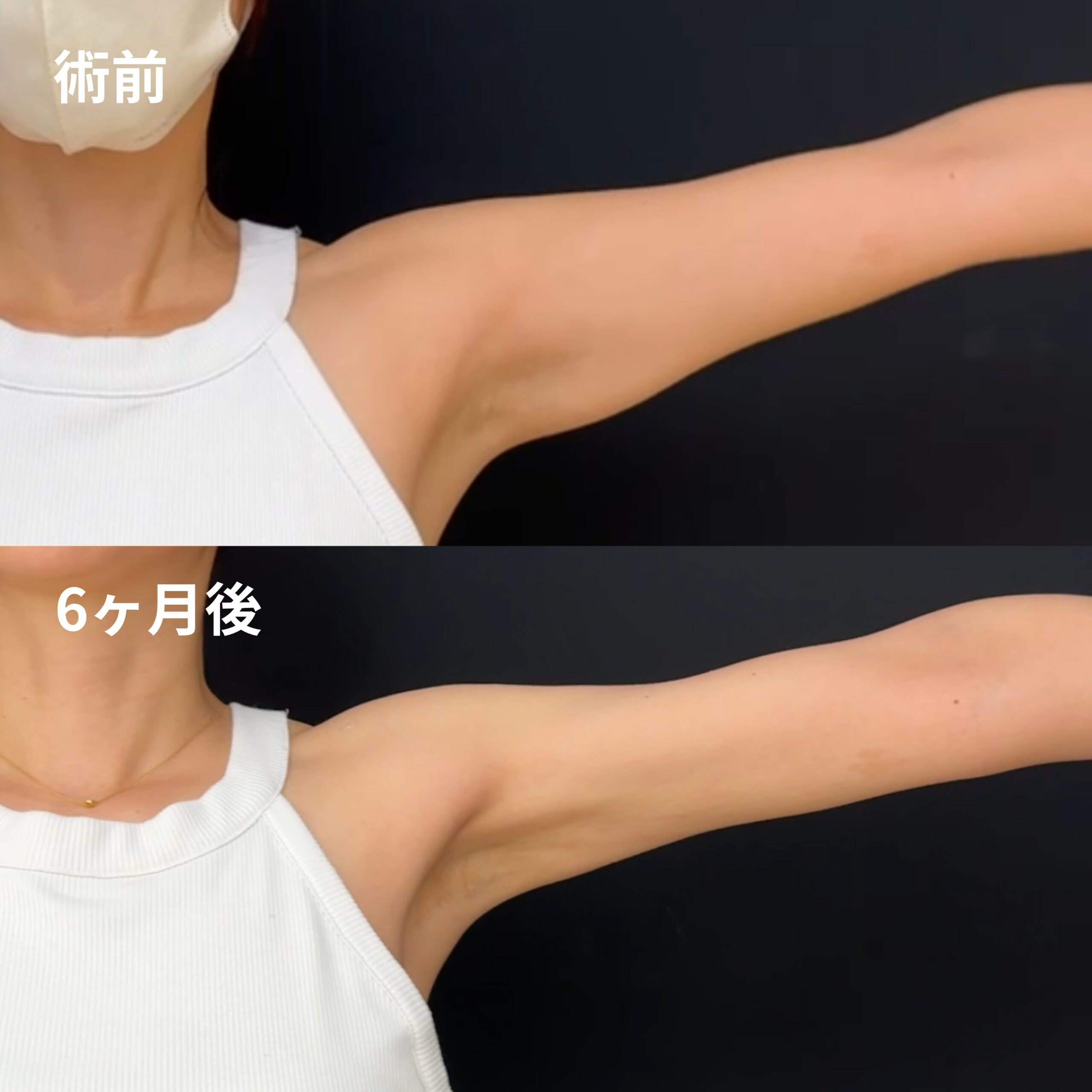 <br />
<b>Warning</b>:  Undefined variable $image_alt in <b>/home/r9092703/public_html/4dclinic.jp/wp/wp-content/themes/4d-clinic/single-case.php</b> on line <b>109</b><br />

