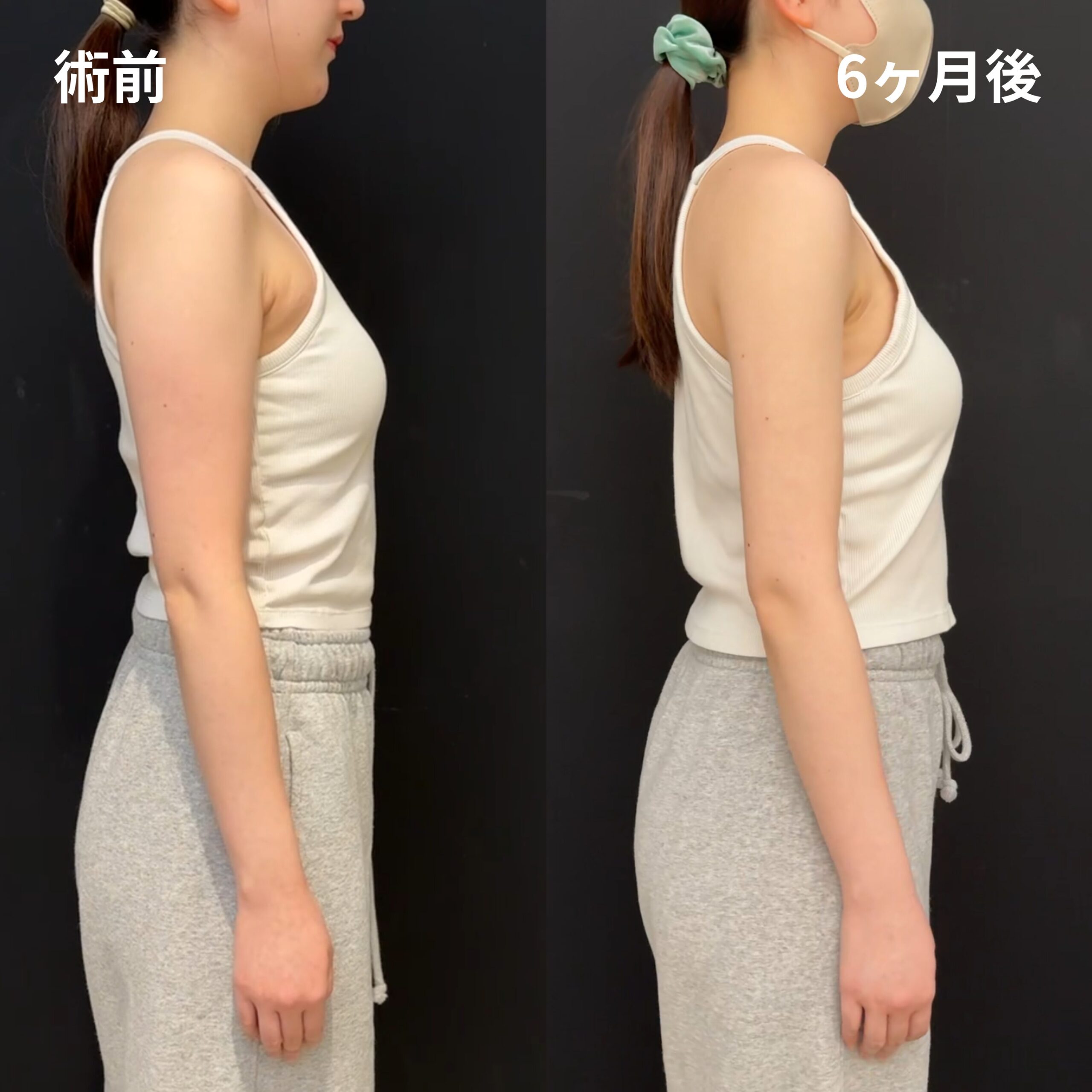 二の腕全周・肩・肩甲骨横・副乳脇肉・ブラ上下・エンブレイスRF（二の腕全周・肩）