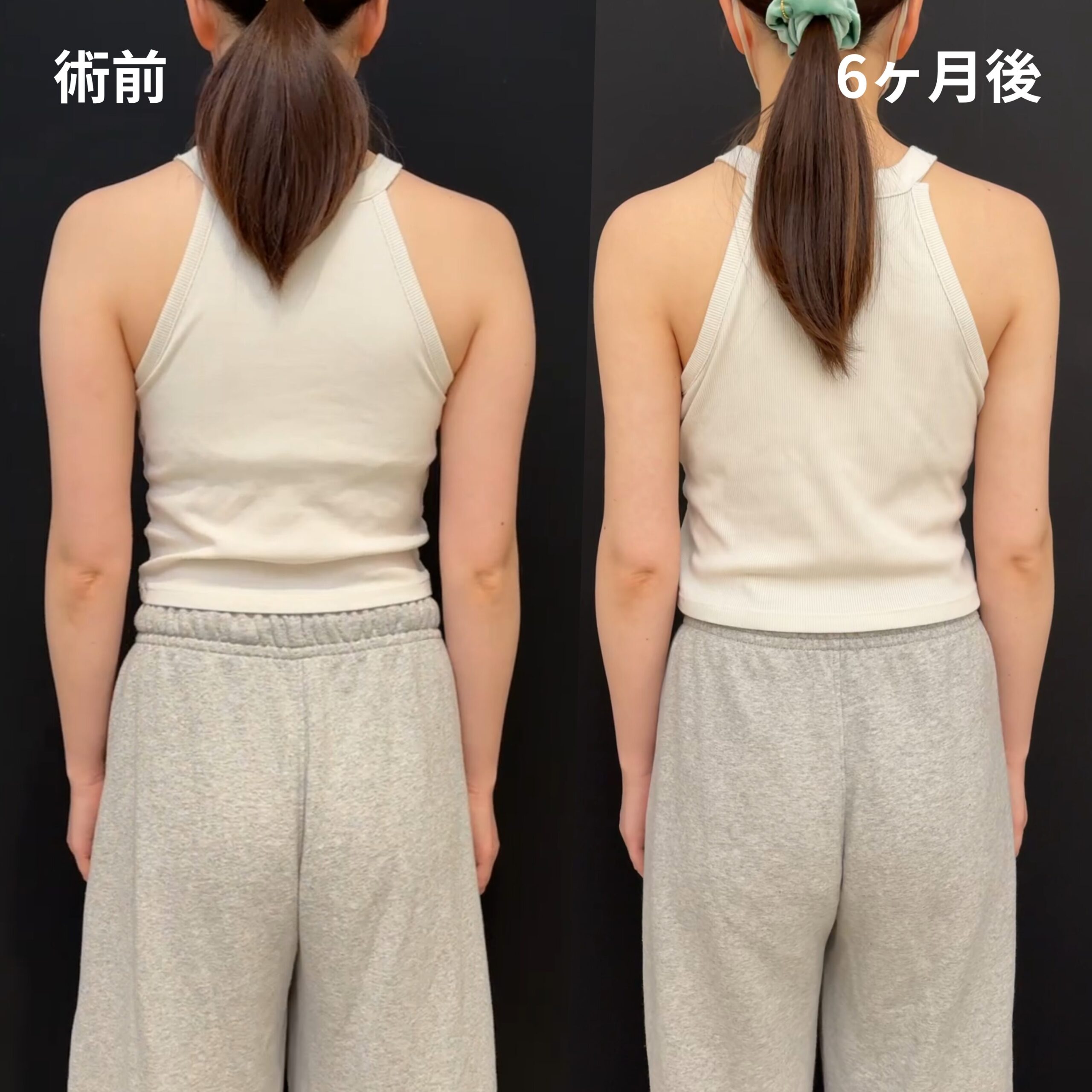 <br />
<b>Warning</b>:  Undefined variable $image_alt in <b>/home/r9092703/public_html/4dclinic.jp/wp/wp-content/themes/4d-clinic/single-case.php</b> on line <b>109</b><br />
