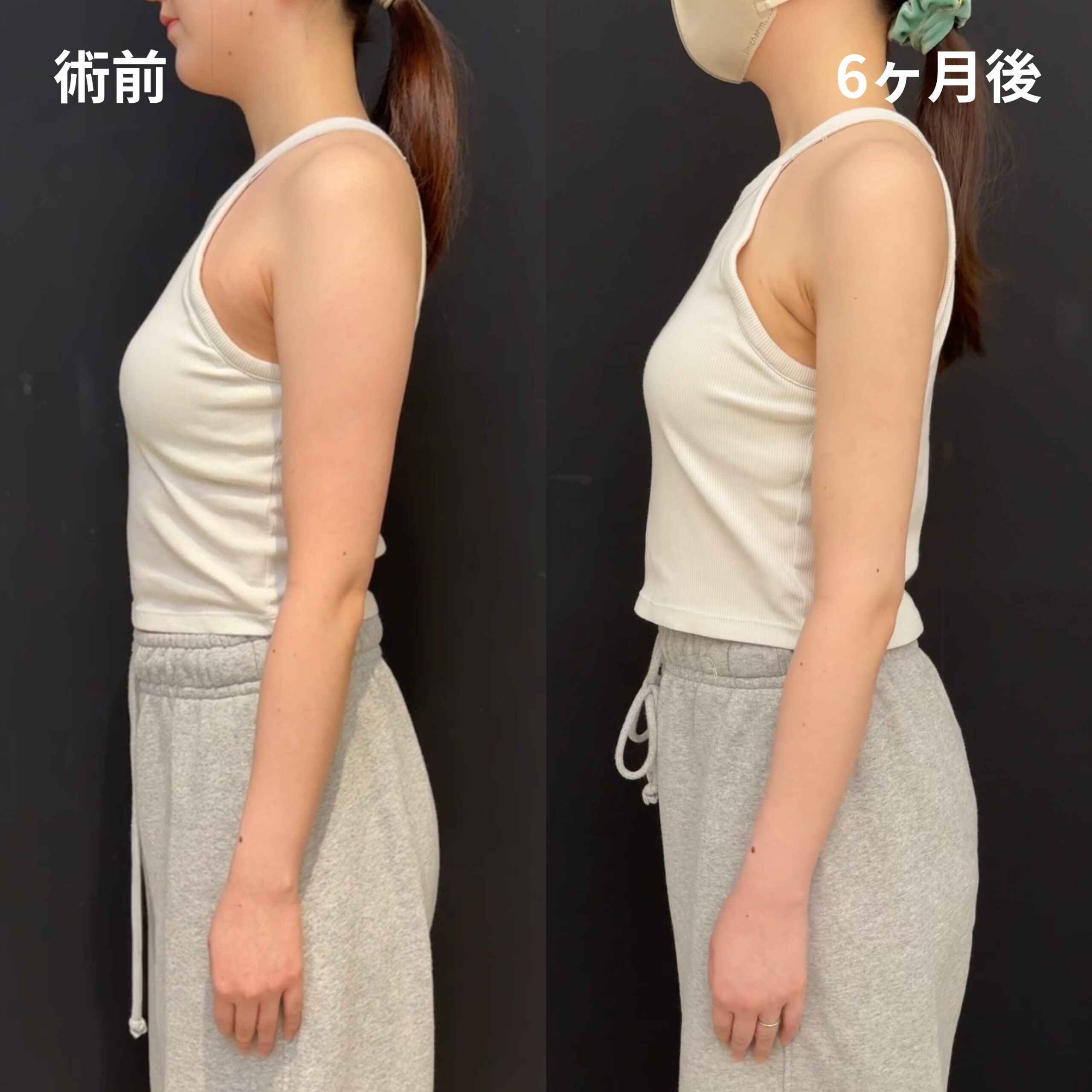 <br />
<b>Warning</b>:  Undefined variable $image_alt in <b>/home/r9092703/public_html/4dclinic.jp/wp/wp-content/themes/4d-clinic/single-case.php</b> on line <b>109</b><br />
