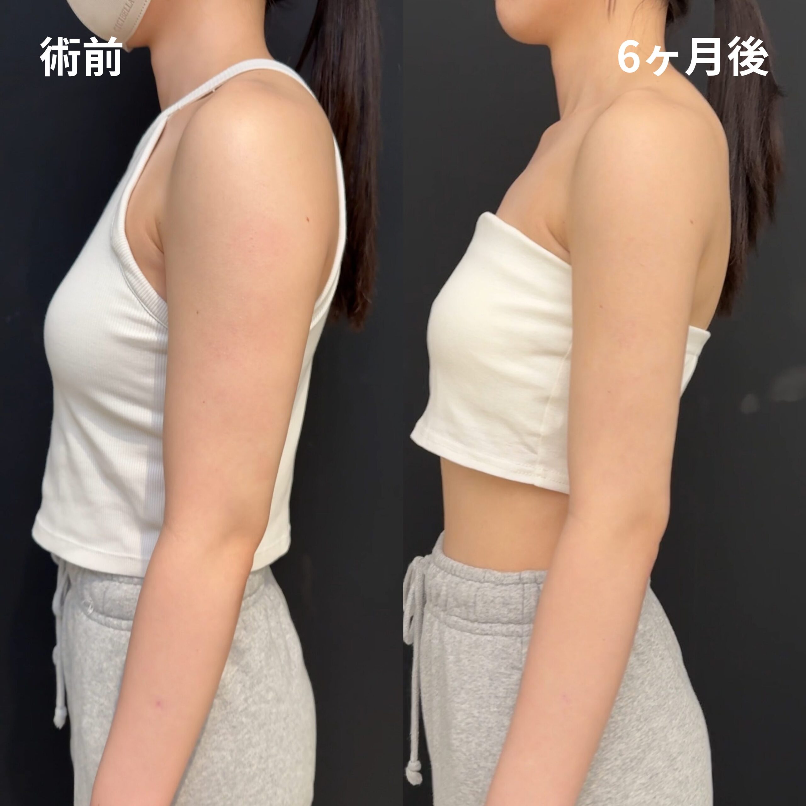<br />
<b>Warning</b>:  Undefined variable $image_alt in <b>/home/r9092703/public_html/4dclinic.jp/wp/wp-content/themes/4d-clinic/single-case.php</b> on line <b>109</b><br />
