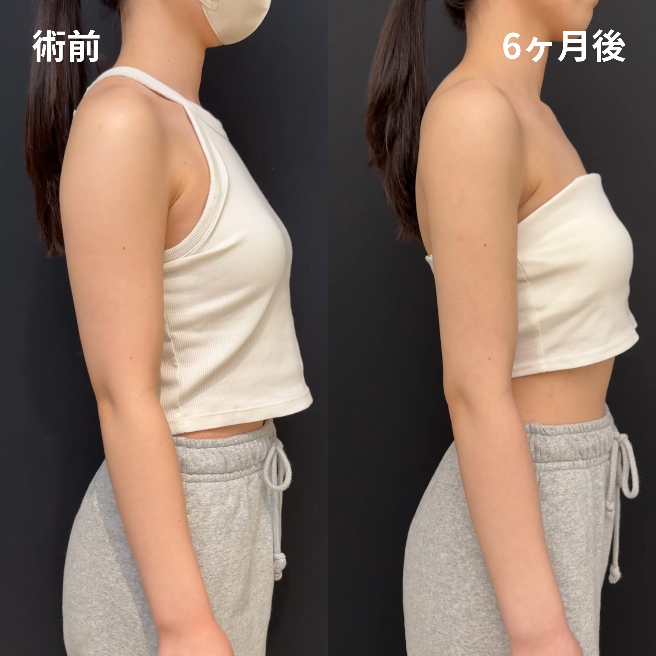 二の腕全周・肩・肩甲骨横・脇肉副乳・エンブレイスRF（二の腕全周・脇肉副乳）