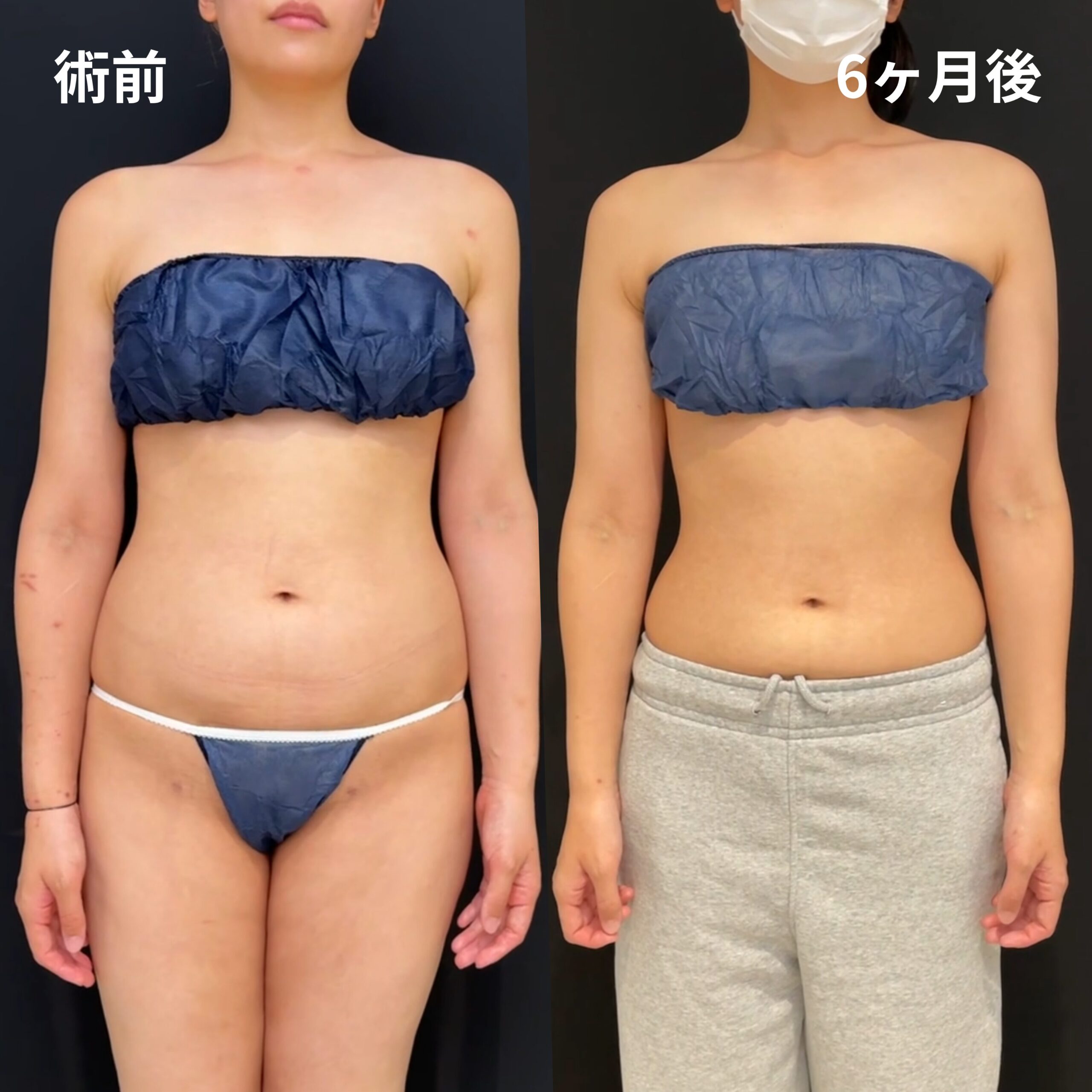 腹部全周