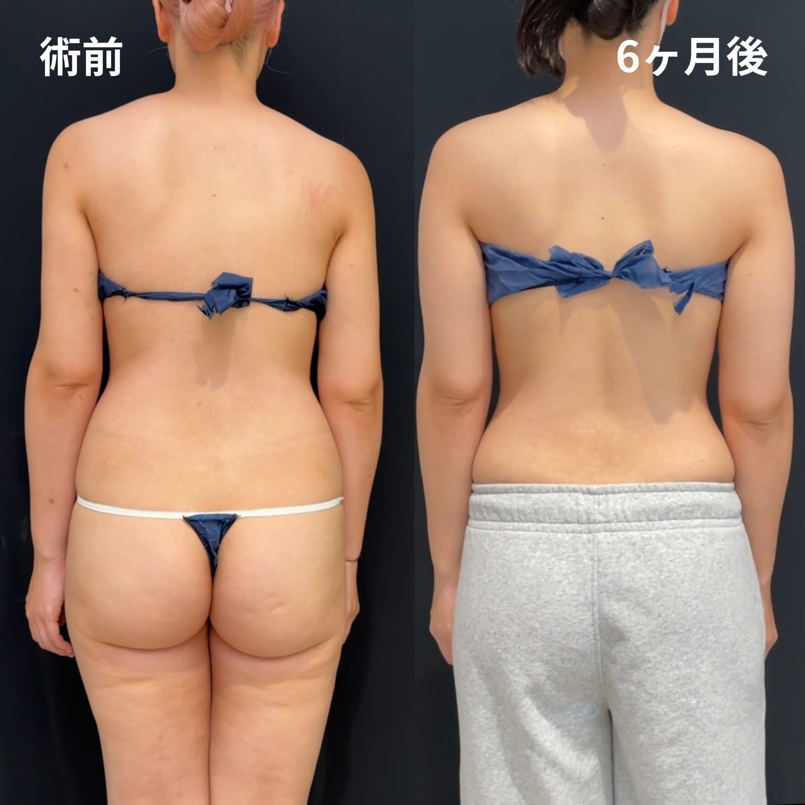<br />
<b>Warning</b>:  Undefined variable $image_alt in <b>/home/r9092703/public_html/4dclinic.jp/wp/wp-content/themes/4d-clinic/single-case.php</b> on line <b>109</b><br />
