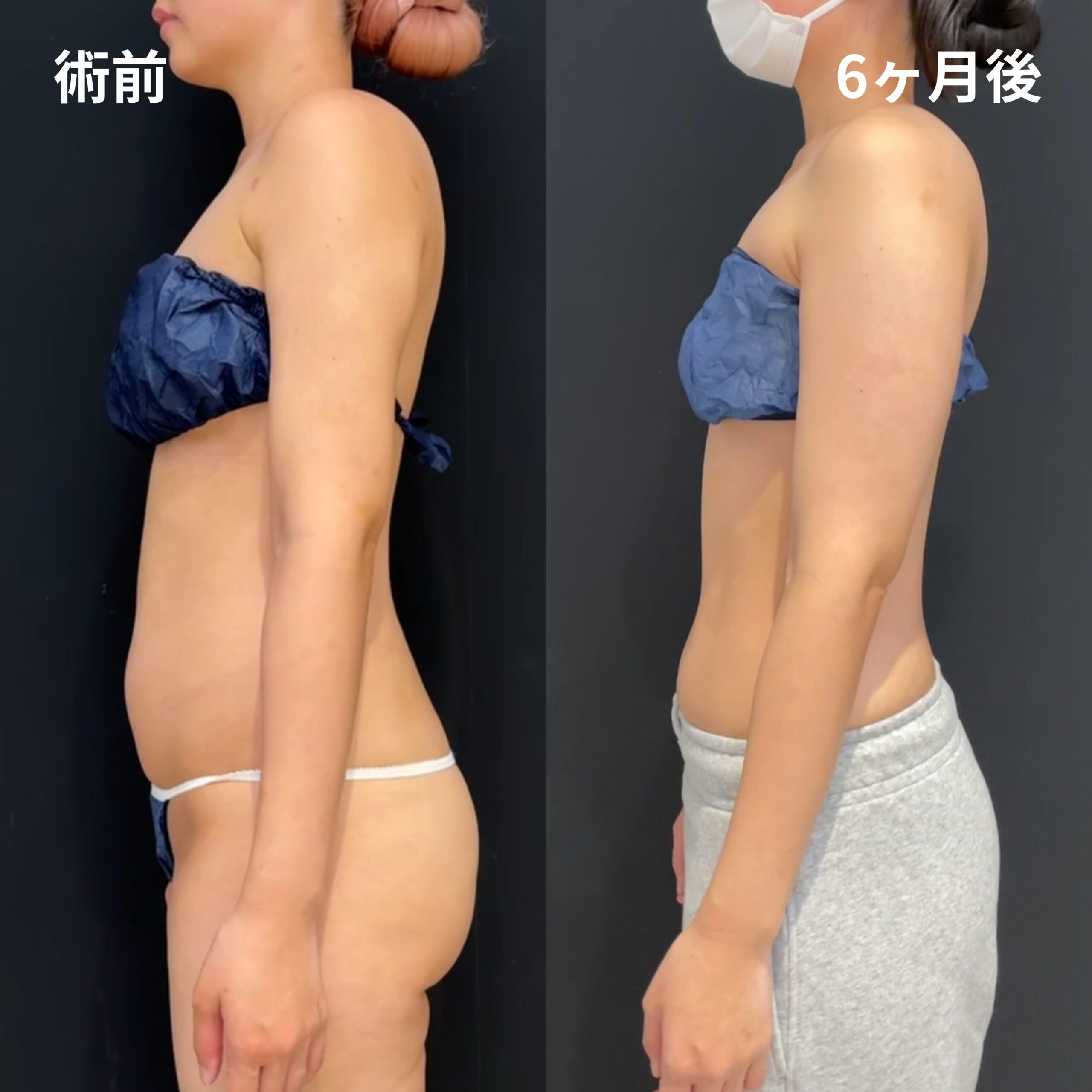<br />
<b>Warning</b>:  Undefined variable $image_alt in <b>/home/r9092703/public_html/4dclinic.jp/wp/wp-content/themes/4d-clinic/single-case.php</b> on line <b>109</b><br />
