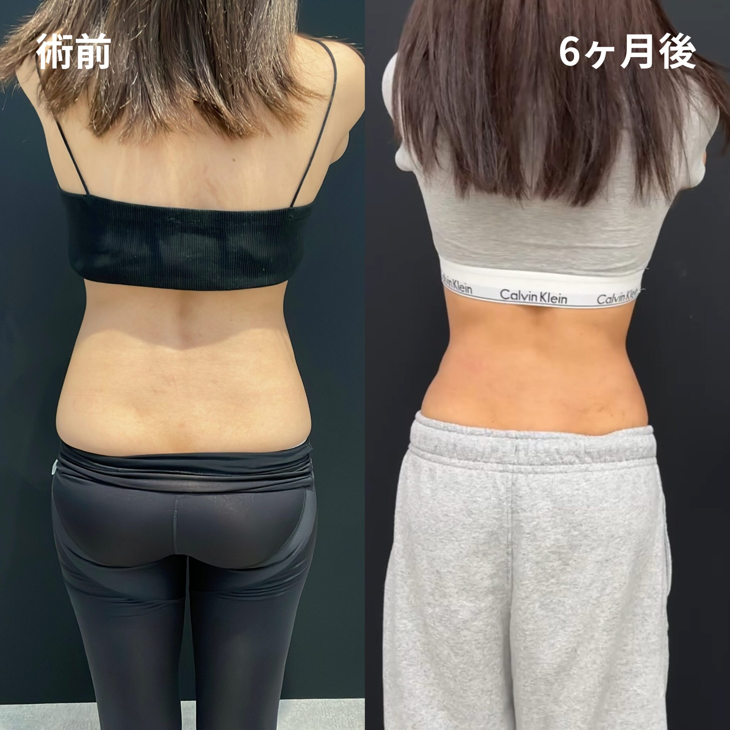 <br />
<b>Warning</b>:  Undefined variable $image_alt in <b>/home/r9092703/public_html/4dclinic.jp/wp/wp-content/themes/4d-clinic/single-case.php</b> on line <b>109</b><br />

