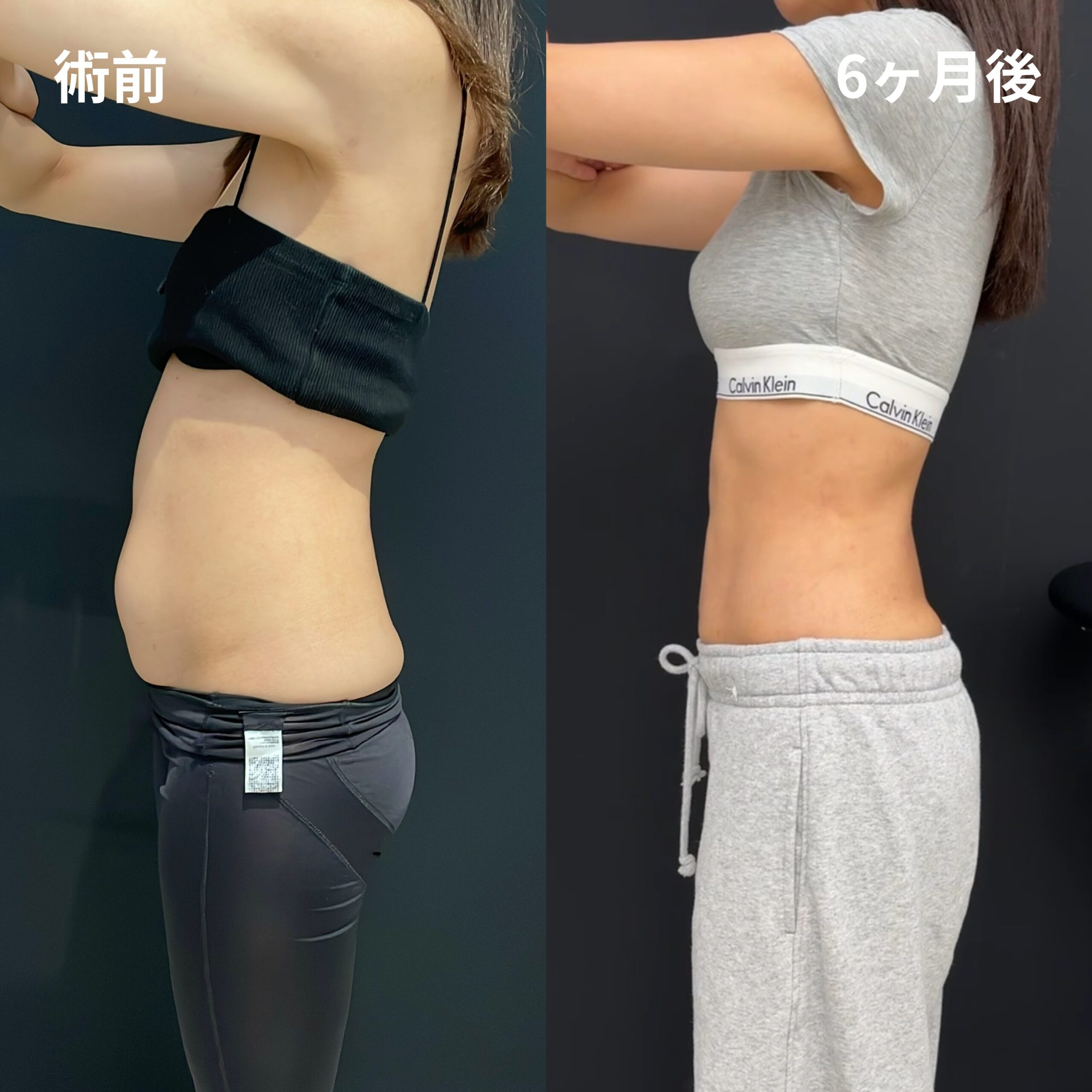 腹部全周