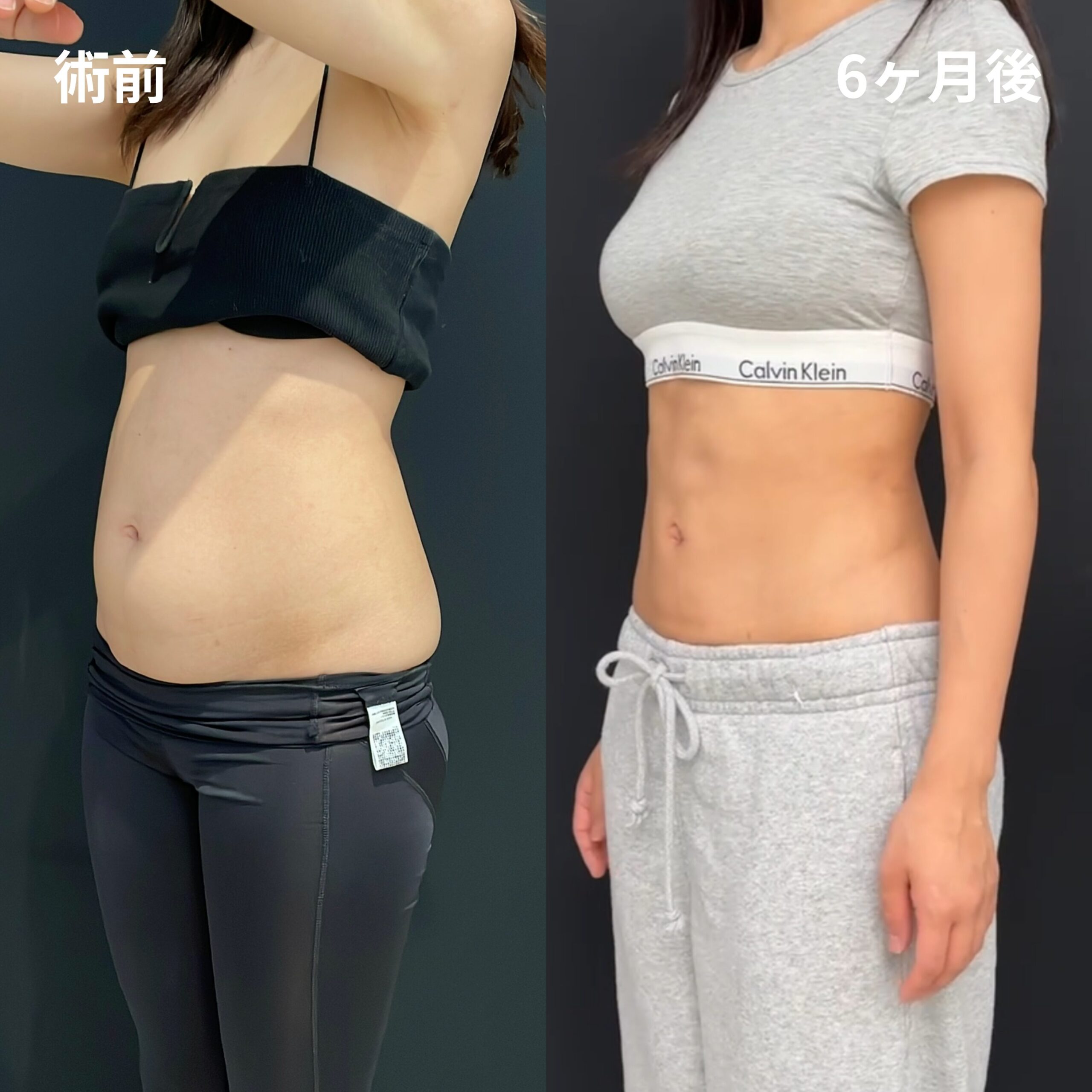 <br />
<b>Warning</b>:  Undefined variable $image_alt in <b>/home/r9092703/public_html/4dclinic.jp/wp/wp-content/themes/4d-clinic/single-case.php</b> on line <b>109</b><br />
