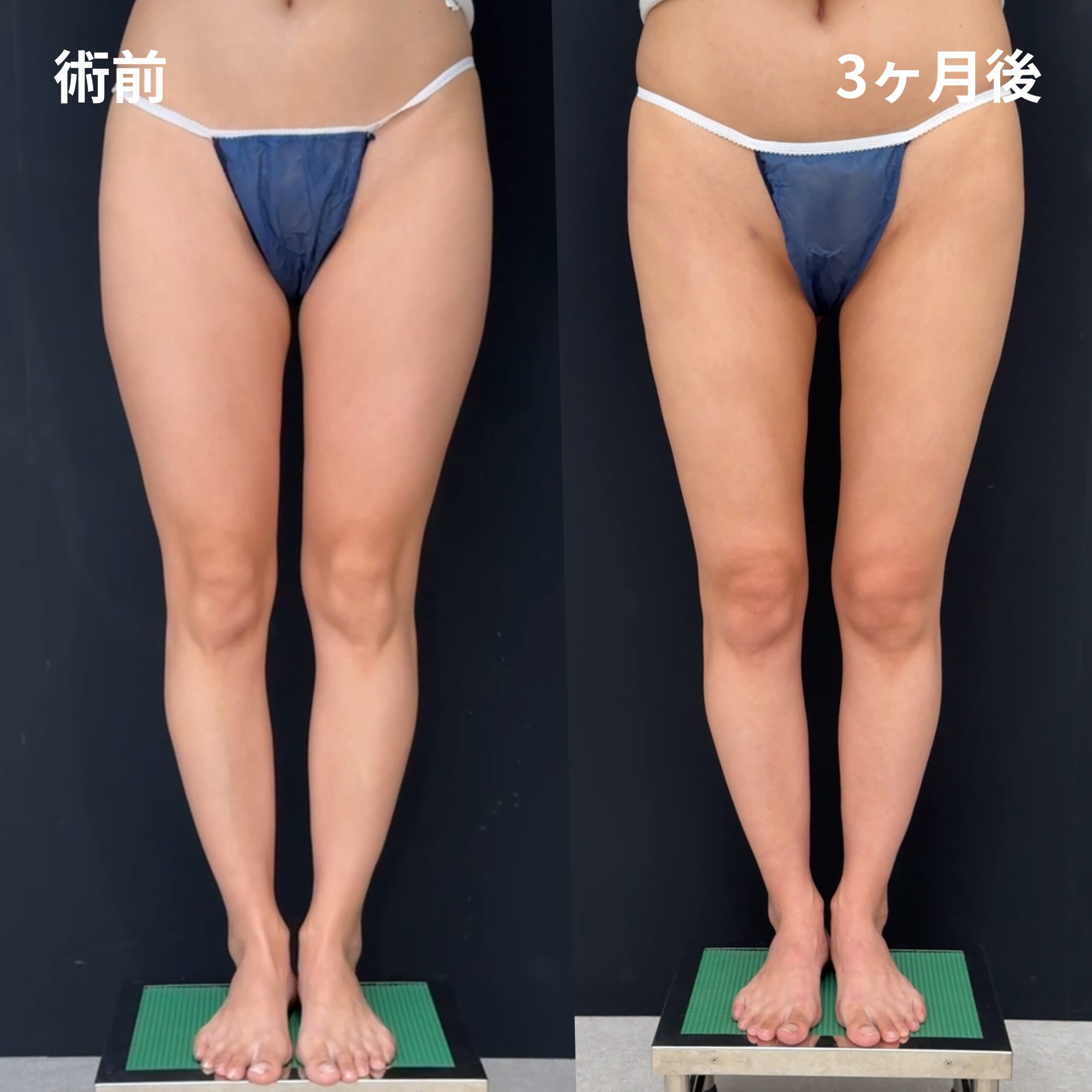 大腿全周・臀部・膝・エンブレイスRF（大腿全周）